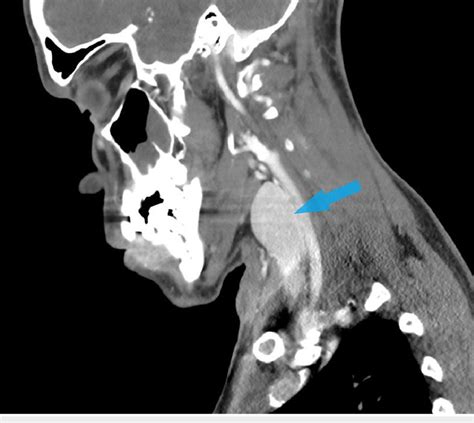 soft tissues in neck ct